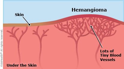гемангіома: що це?
