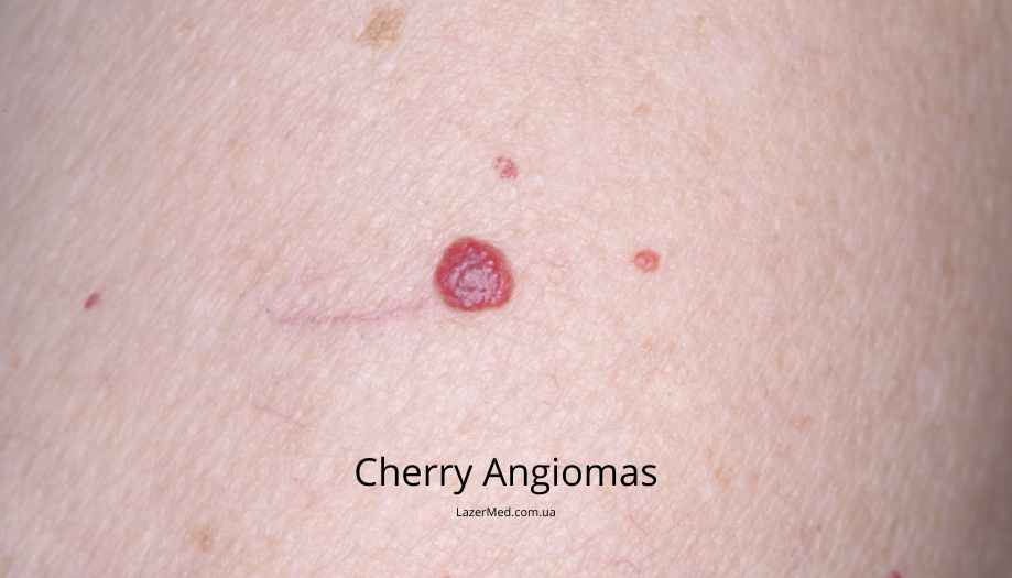 Красные ангиомы (Cherry Angiomas)