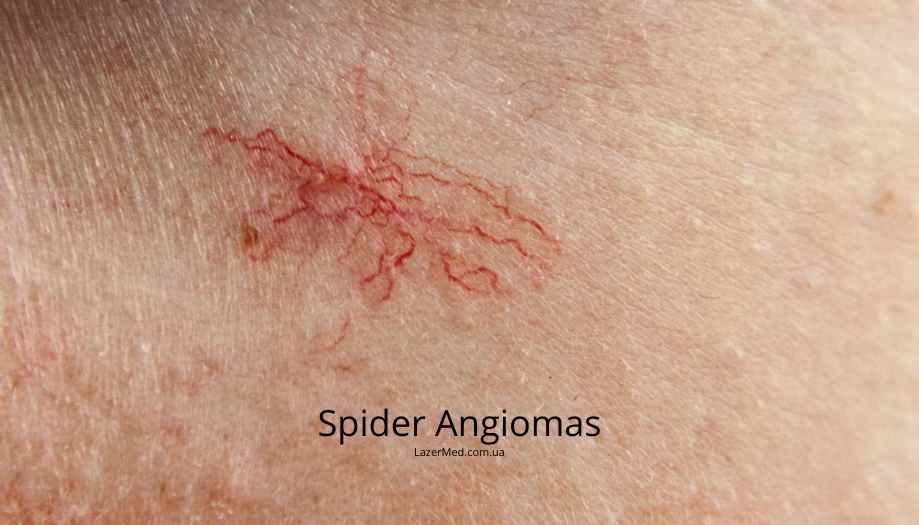 Паучковидные ангиомы (Spider Angiomas)