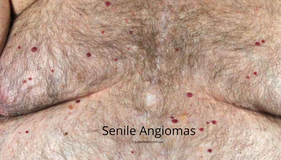 Старческие ангиомы (Senile Angiomas)