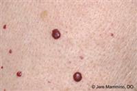 angioma cherry low photo