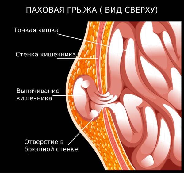 Паховая грыжа вид сверху рисунок